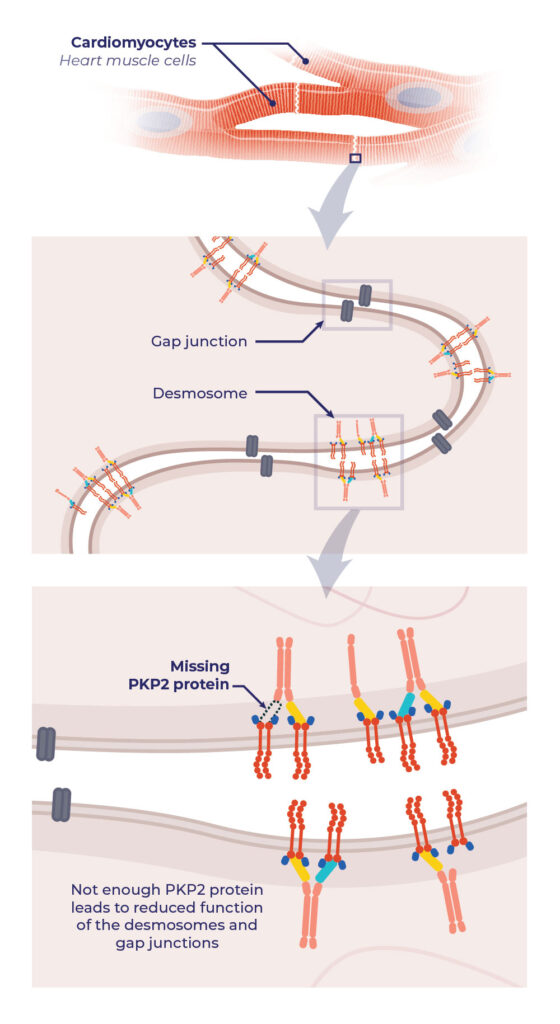 About ARVC (Arrhythmogenic Right Ventricular Cardiomyopathy) - Tenaya ...